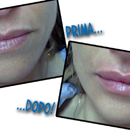 Filler: come funziona il trattamento che restituisce volume alle labbra e copre le rughe