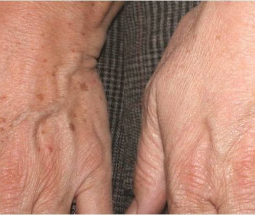 Rimozione macchie della pelle: con il laser Q-Switched puoi